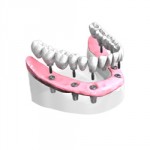 Pose d’un bridge complet sur implants dentaires
