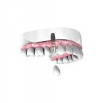 Pose d’une couronne dentaire sur implant