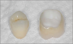 ZIRCONE-couronne-dentaire-sans-métal
